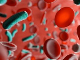 sepsis